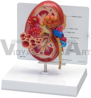 Diseased Kidney